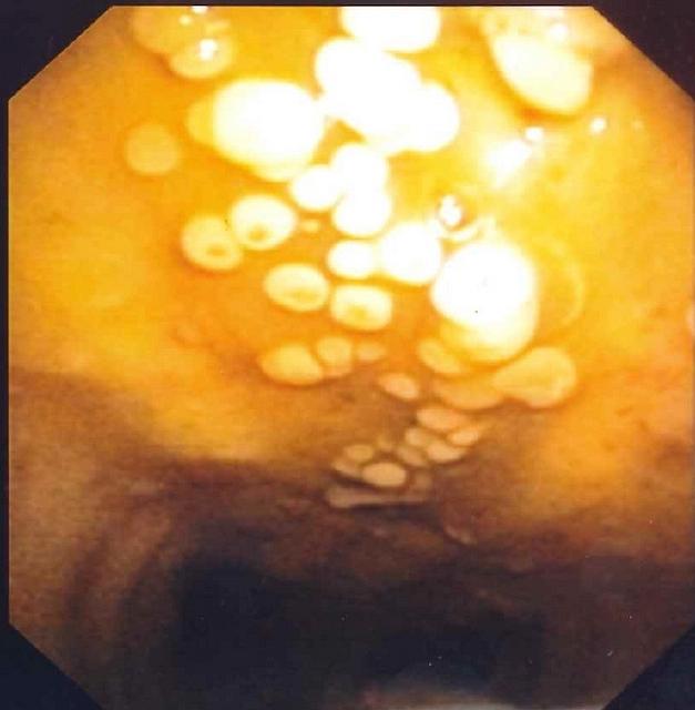 Endobronchial aspergillosis