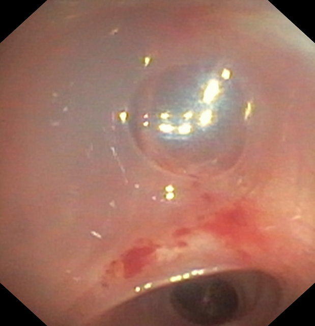 Bronchoalveolar lavage in alveolar proteinosis (photo taken during aspiration of BAL)