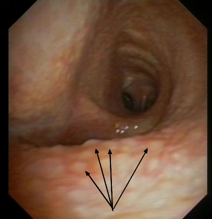 Endobronchial sarcoidosis