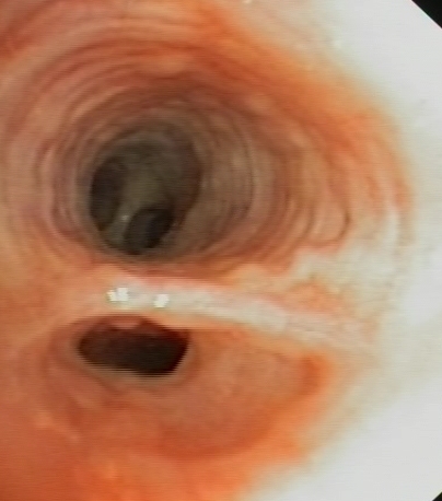 Endobronchial sarcoidosis