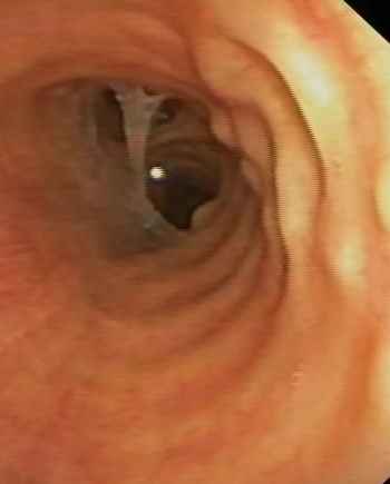 Tracheopathia osteochondroplastica