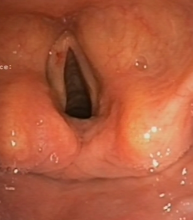 Paralysis of the left vocal cord