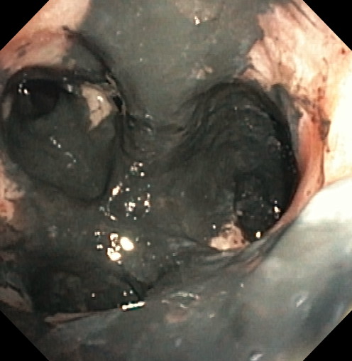 Soot deposition as a result of smoke inhalation