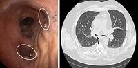 Accessory cardiac bronchus