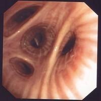 Anatomic Variations of the Right Lower Lobe