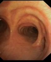 Anatomic Variations of the Right Upper Lobe