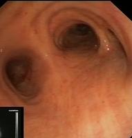 Tracheal bronchus