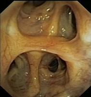 Quadrifurcation of the right upper lobe