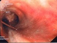 Thread-like (stringy), hemorrhagic secretions