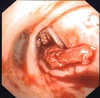 Blood clot and active hemorrhage