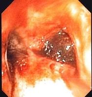 Blood clot