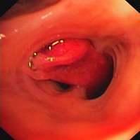 Blood clot