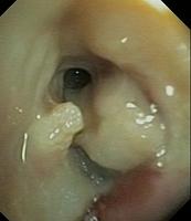 Endobronchial fibrin deposition