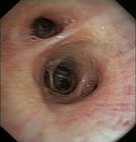 Carinas of the right lung