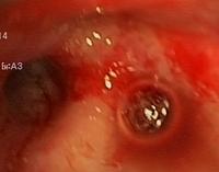 Hemorrhagic mucosa and widening of the carinas of the RUL