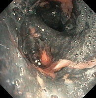 Inhalation injury and soot deposition
