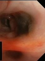 Melanoma