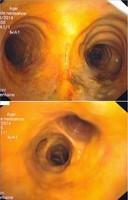 Icteric mucosa