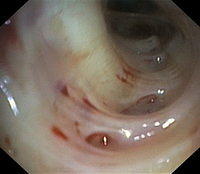 Pale mucosa
