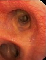 Hypervascularized mucosa