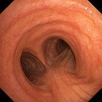 General aspect of the mucosa and the bronchial wall