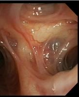 Atrophic mucosa