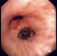 Congestive mucosa (oedematous, erythematous)