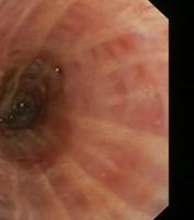 Hyperelastosis of the mucosa