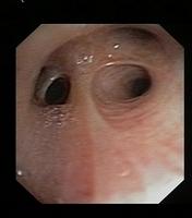 Normal Mucosa