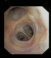 Normal Mucosa