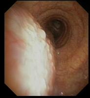 Surface of the mucosa and Continuity of the bronchial wall