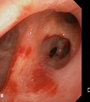 Abrasion of the mucosa