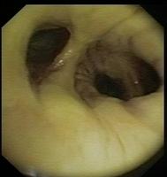 Deposition of fibrin
