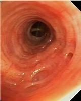 Dilated bronchial gland orifice