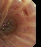 Dilated bronchial gland orifice
