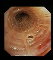 Dilated bronchial gland orifice