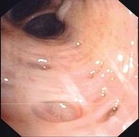 Dilated bronchial gland orifices