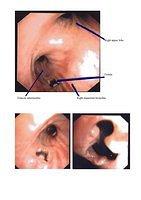 Fistulas
