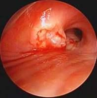 Broncho-eosophageal fistula (Case 2)