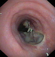 Tracheoesophageal fistula