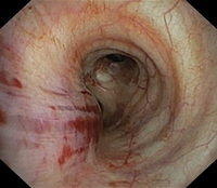 Hematoma