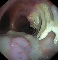 Tracheoesophageal fistula with erosion of the tracheal rings
