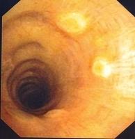 Multiple, raised and circumscribed lesions