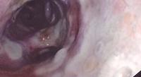 White friable membranes and apthoid-looking lesions