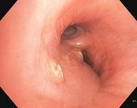 Whitish caseous and ulcerous lesion
