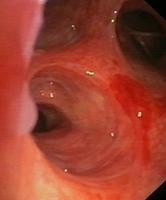 Vesicle lesions (and bronchial ulcer)