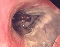 Extensive necrosis of the mucosa