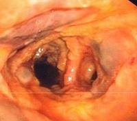 Superficial necrosis of the mucosa