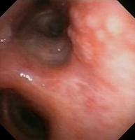 Nodular mucosa