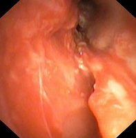Perforation or rupture of the bronchial wall